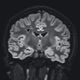 A MRI scan of one of the patients, with the arrow pointing to a suspected lesion.